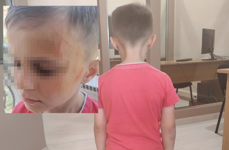Επεισόδιο σε νηπιαγωγείο του Αγρινίου που, όπως καταγγέλλεται, είχε ως αποτέλεσμα να τραυματιστεί στο πρόσωπο ένας 5χρονος, σημειώθηκε το πρωί της Τρίτης (10.6.25) στο προαύλιο του σχολείου. 